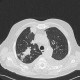 Bronchoinvasive aspergilosis: CT - Computed tomography